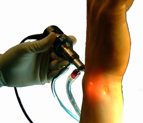 Wrist Arthroscopy A Primer The Hand Surgery Clinics Pune